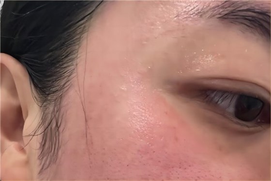 皮膚過敏 皮膚過敏